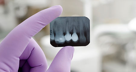 Svullet och kliande tandk&ouml;tt