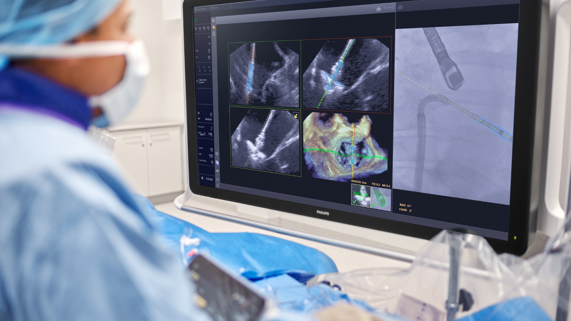 Philips f&ouml;r in AI i hj&auml;rtat av operationssalen &ndash; st&ouml;ttar l&auml;kare i realtid under hj&auml;rtklaffsreparation